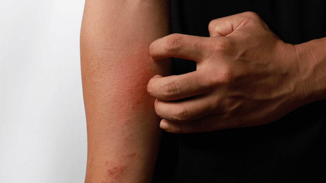 Psoriasis, eczéma : le meilleur traitement naturel pour les soulager